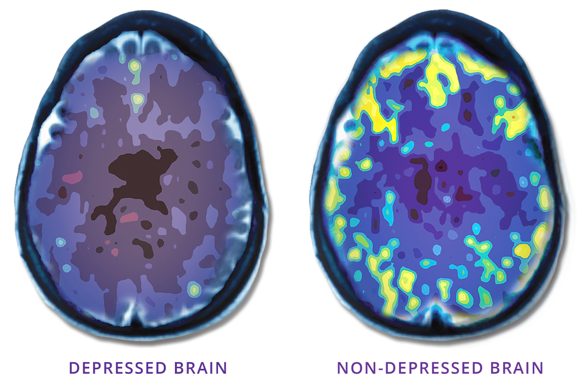 NeuroStar TMS | Brain Comparison