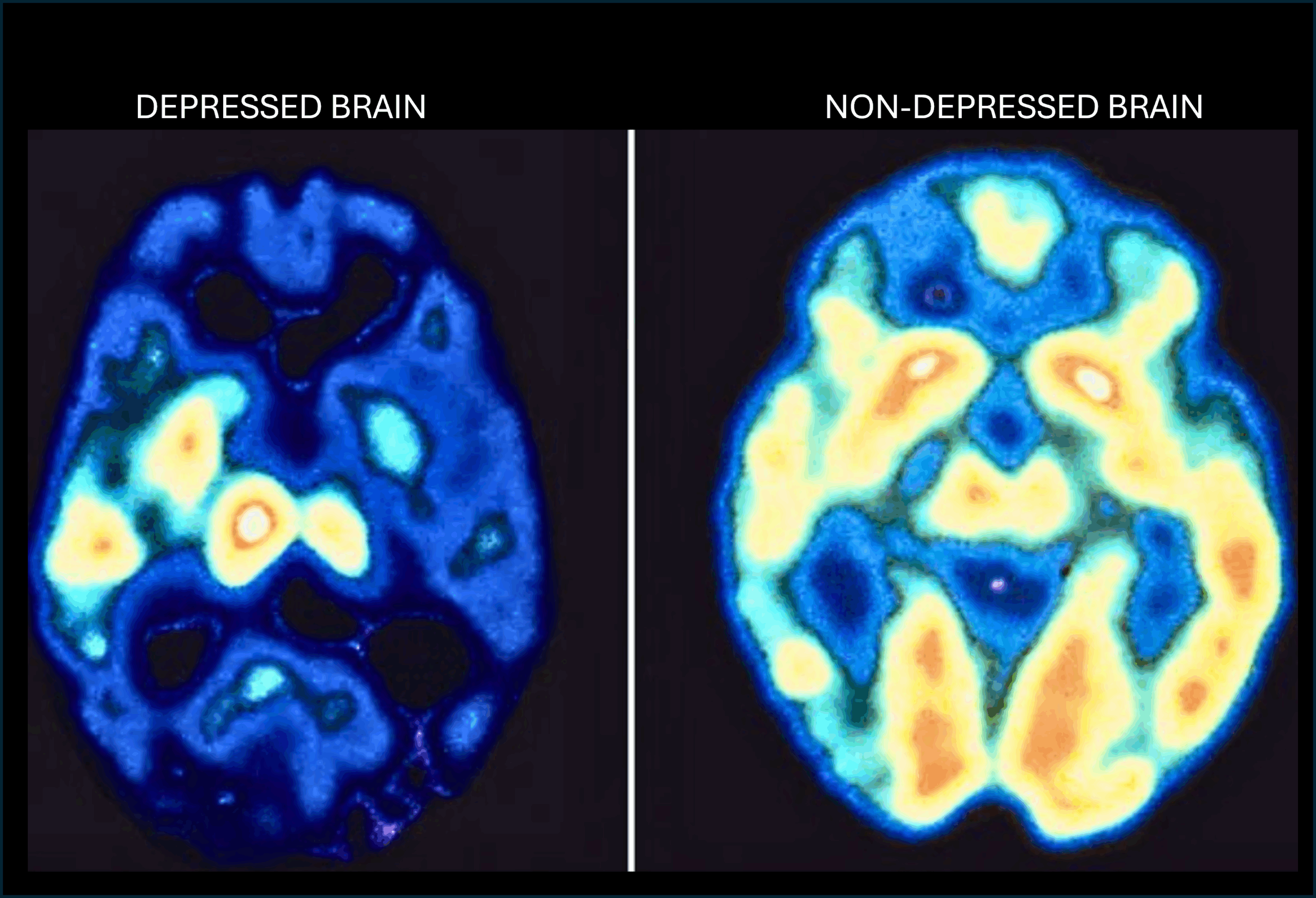 Brain